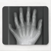 Six Fingered Hand, Medical Rarity, X-Ray mousepads