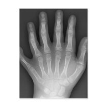 Six Fingered Hand, Medical Rarity, X-Ray postcards by harlowandcompany Six Fingered Hand, Medical Rarity, X-Ray postcards