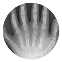 Six Fingered Hand, Medical Rarity, X-Ray stickers by harlowandcompany Six Fingered Hand, Medical Rarity, X-Ray stickers