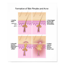 Skin Acne and pimples Poster