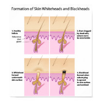Skin blackhead Poster