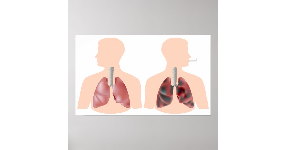 Smoking And Lung Cancer Poster Zazzle