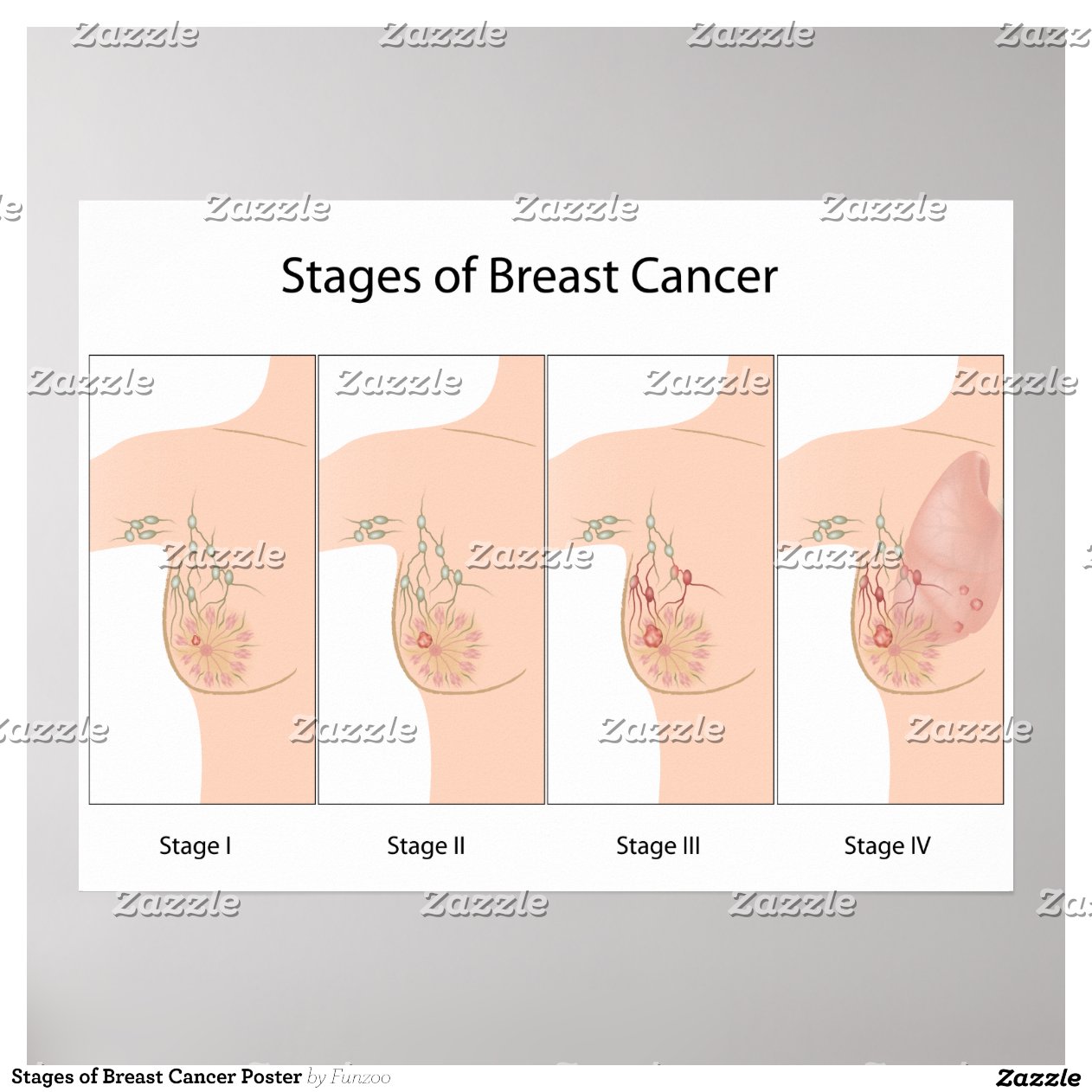 Stages_of_breast_cancer_poster-r3a499288c0f946a9be4536df86446994_ozg5 ...