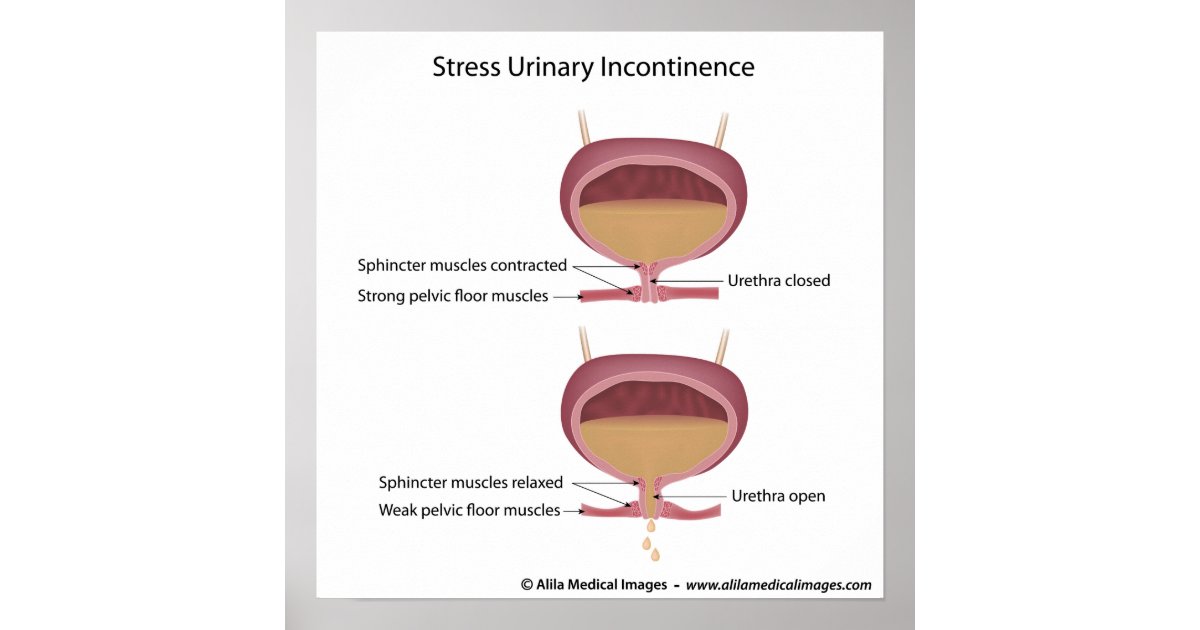 Stress Urinary Incontinence In Women Poster Zazzle