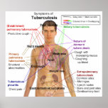 Symptom Chart of Tuberculosis in Humans posters