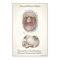 The Effects of Untreated Syphilius. posters