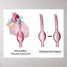 Thoracic aortic aneurysm surgery Poster