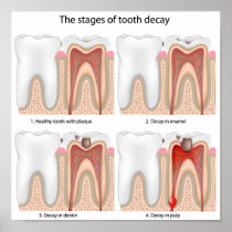 Tooth decay Poster