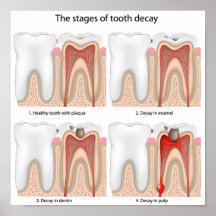 Tooth decay Poster