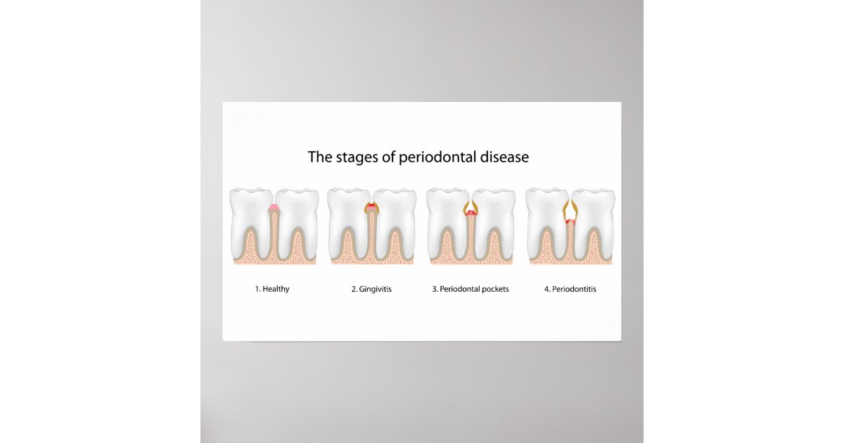 Tooth Periodontal Disease Poster Zazzle