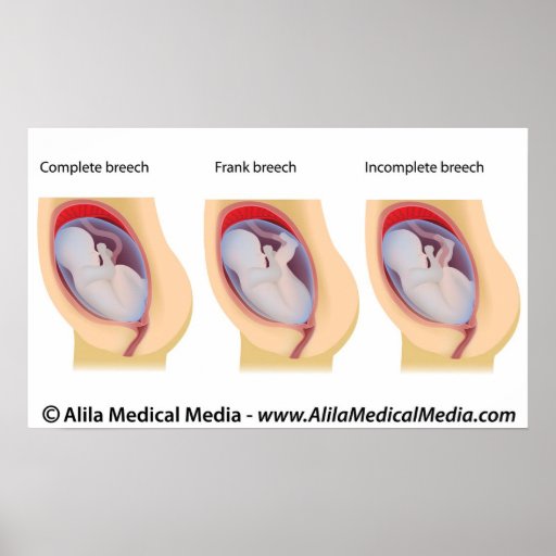 Types of breech birth positions poster Zazzle