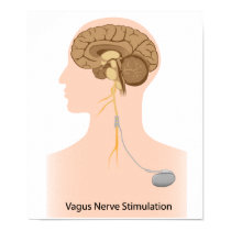 Vagus nerve stimulation therapy Poster