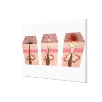 View of what causes acne canvas print