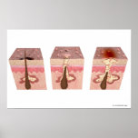 View of what causes acne poster