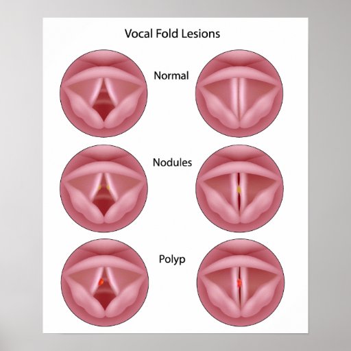 vocal-cord-lesions-poster-zazzle