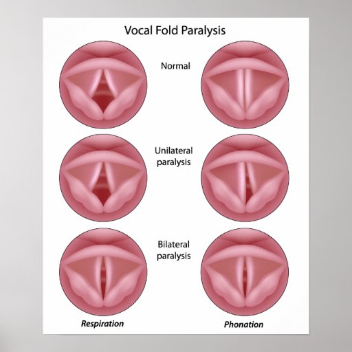 Vocal Cord Paralysis Poster Zazzle 8141