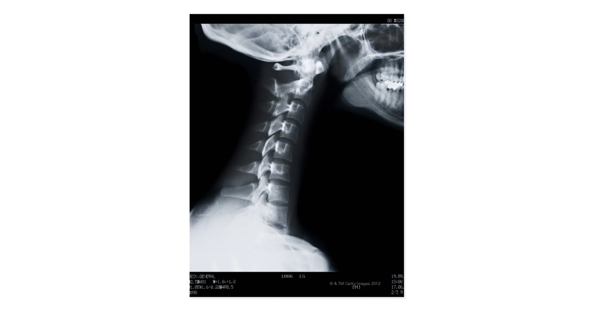 X ray of neck vertebrae including lower jaw postcard Zazzle