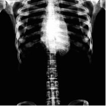 X-RAY SKELETON TORSO RIBS - B&W ACRYLIC CUT OUT
