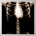 X-RAY SKELETON TORSO RIBS - SEPIA PRINT