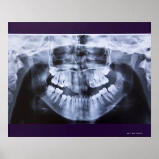 Xray of a girls jawline taken with a panoramic poster Zazzle