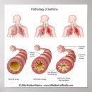Search for allergy posters Doctor