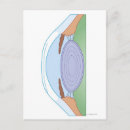 Search for eye surgery Medical