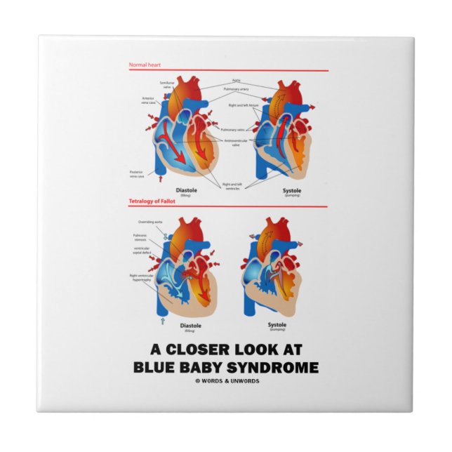 A Closer Look At Blue Baby Syndrome Heart Anatomy Ceramic Tile (Front)