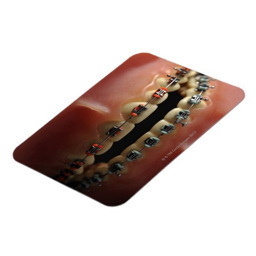 A Dental Model And Teeth Braces Magnet Zazzle