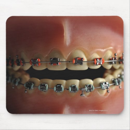 A dental model and Teeth braces Mouse Pad