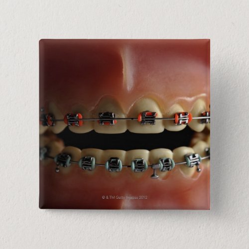 A dental model and Teeth braces Pinback Button