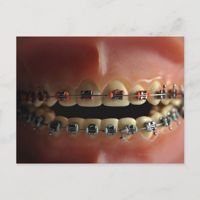 A dental model and Teeth braces Postcard (Front)