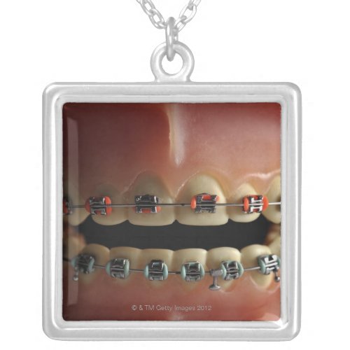 A dental model and Teeth braces Silver Plated Necklace