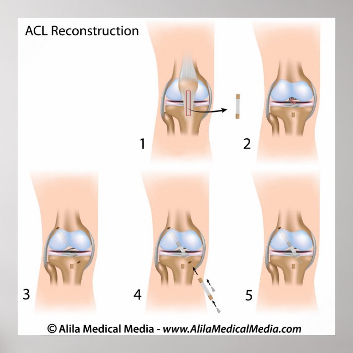 ACL reconstruction surgery diagram. Posters