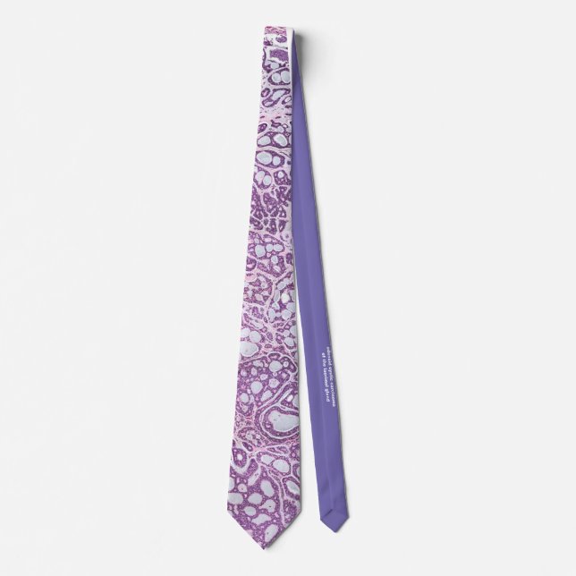 Adenoid cystic carcinoma lacrimal gland neck tie (Front)
