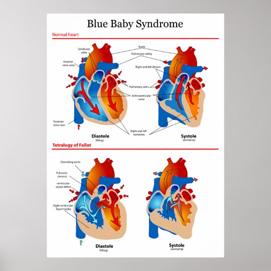 Anatomical Heart Diagram Of Blue Baby Syndrome Poster