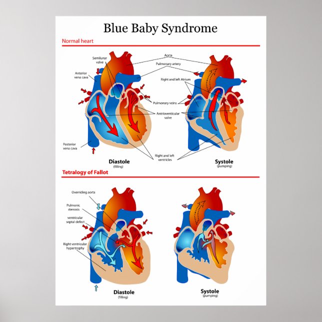 Anatomical Heart Diagram of Blue Baby Syndrome Poster (Front)