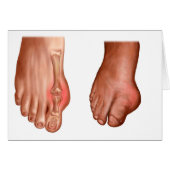 Anatomy Of A Swollen Foot (Front Horizontal)