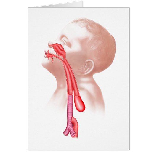 Anatomy Of A Tracheoesophageal Fistula (Front)