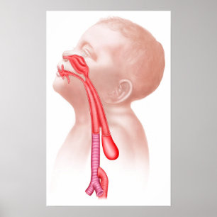 Anatomy Of A Tracheoesophageal Fistula Poster