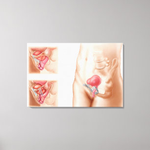 Anatomy Of Bladder Suspension Procedure Canvas Print