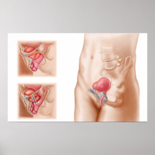 Anatomy Of Bladder Suspension Procedure Poster