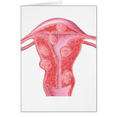 Anatomy Of Fibroid Tumors In Female Uterus (Front)