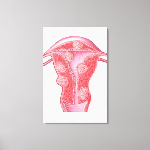 Anatomy Of Fibroid Tumors In Female Uterus Canvas Print