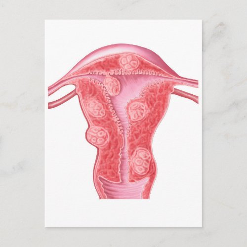 Anatomy Of Fibroid Tumors In Female Uterus Postcard