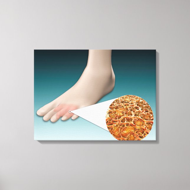 Anatomy Of Foot Fungus With Microscopic Close-Up Canvas Print (Front)