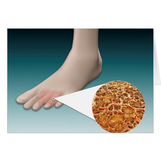 Anatomy Of Foot Fungus With Microscopic Close-Up Cards (Front Horizontal)