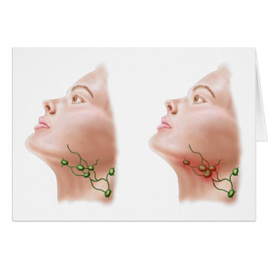 Anatomy Of Swollen Lymph Nodes Cards (Front Horizontal)