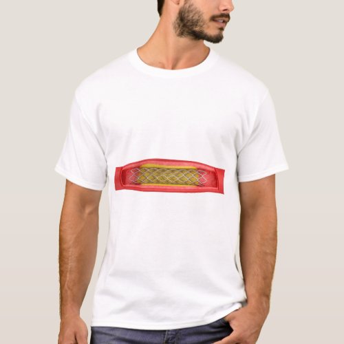 Angioplasty with stent placement T_Shirt