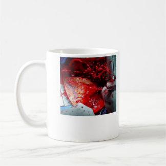 Ascending Aortic Dissection Coffee Mug
