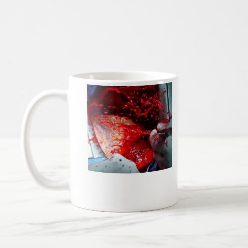 Ascending  Aortic  Dissection Coffee Mug